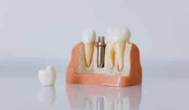 implanti za zube – sve o njima