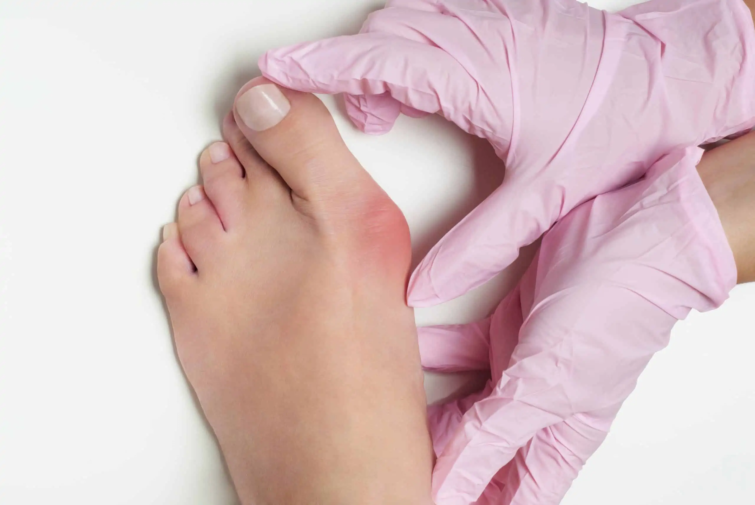 deformacije stopala - uzrok, simptomi, liječenje