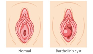 bartolinijeva cista – uzrok, simptomi, liječenje
