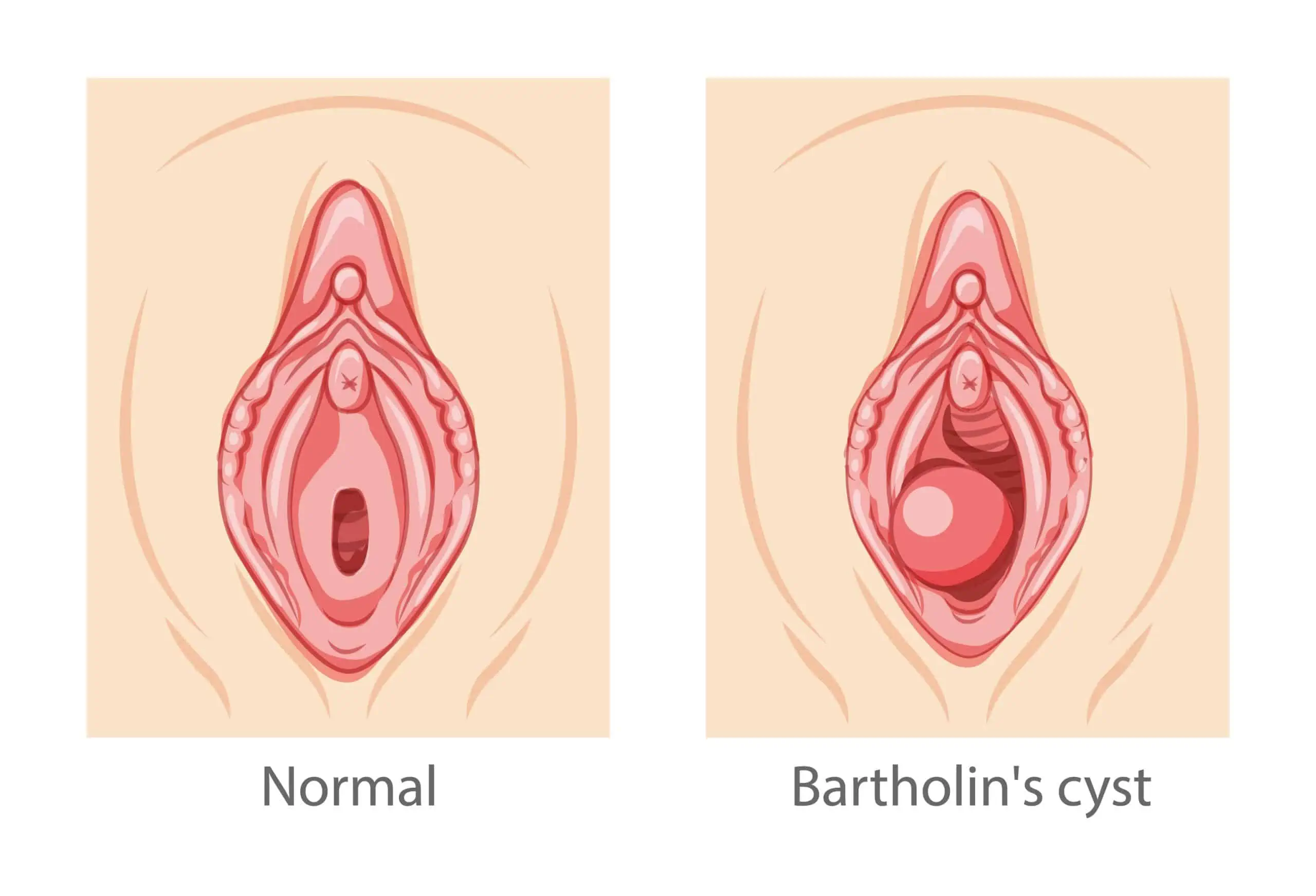 bartolinijeva cista - uzrok, simptomi, liječenje