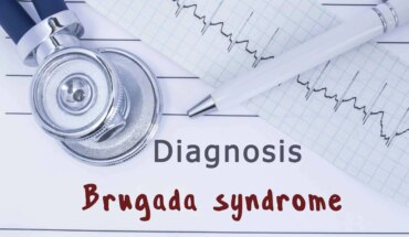 brugada sindrom – uzrok, simptomi, liječenje
