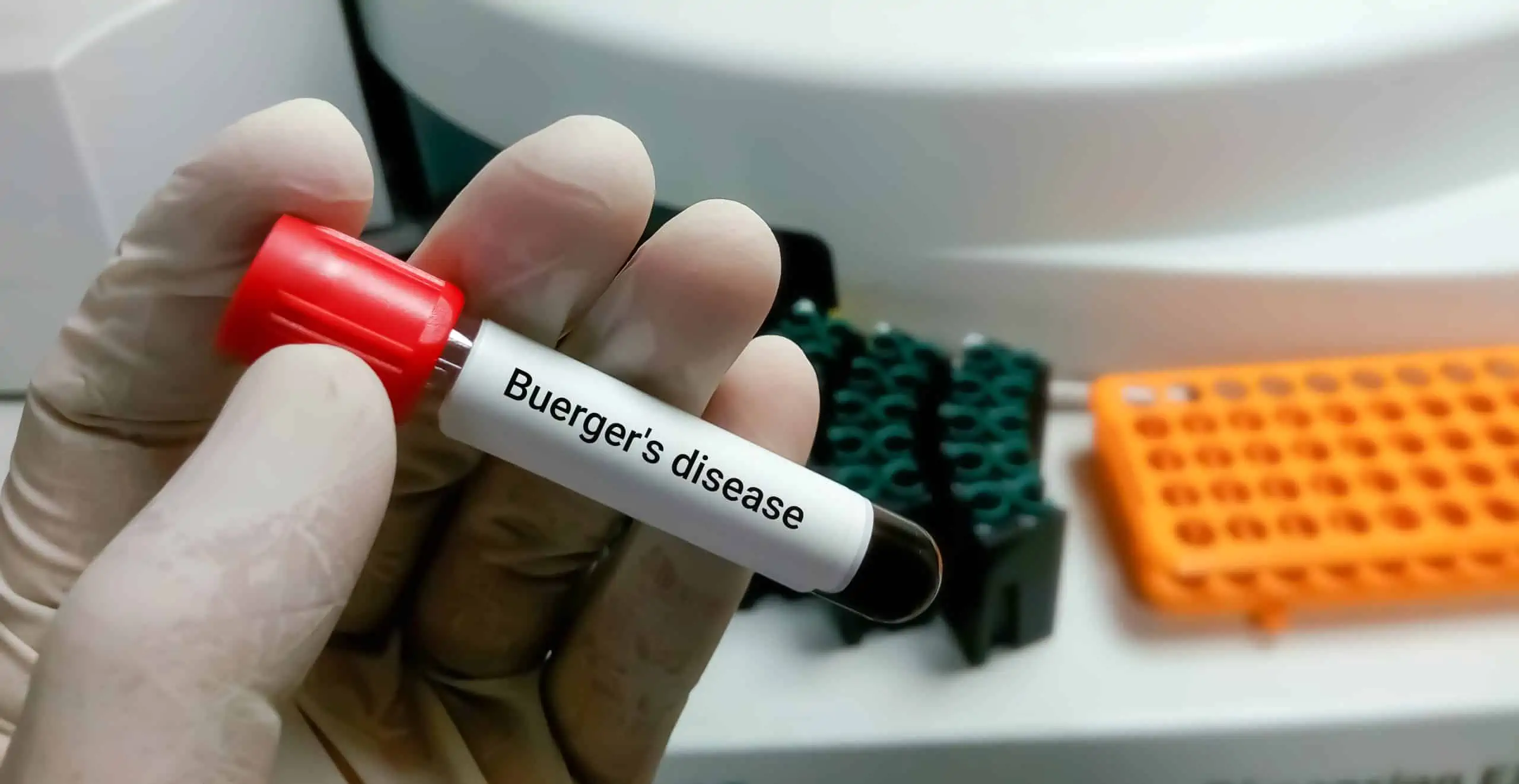 buergerova bolest - uzrok, simptomi, liječenje