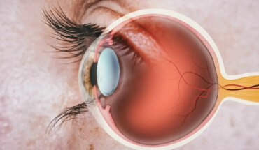 centralna serozna retinopatija – uzrok, simptomi, liječenje