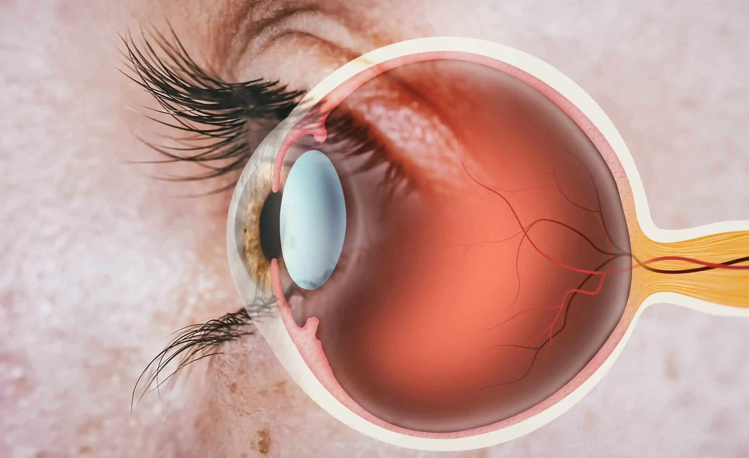 centralna serozna retinopatija - uzrok, simptomi, liječenje