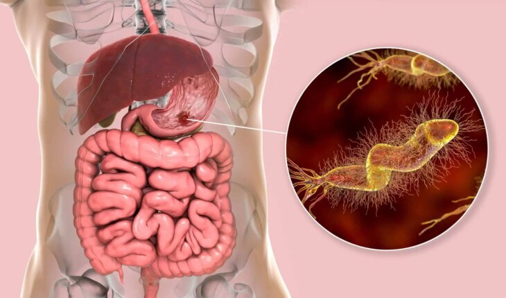 čirevi i karbunkuli – uzrok, simptomi, liječenje