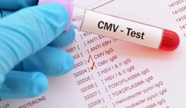 citomegalovirus – uzrok, simptomi, liječenje