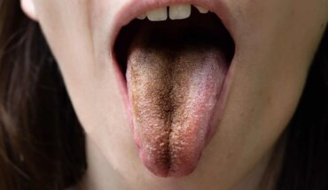crni jezik – uzrok, simptomi, liječenje