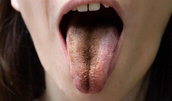 crni jezik – uzrok, simptomi, liječenje