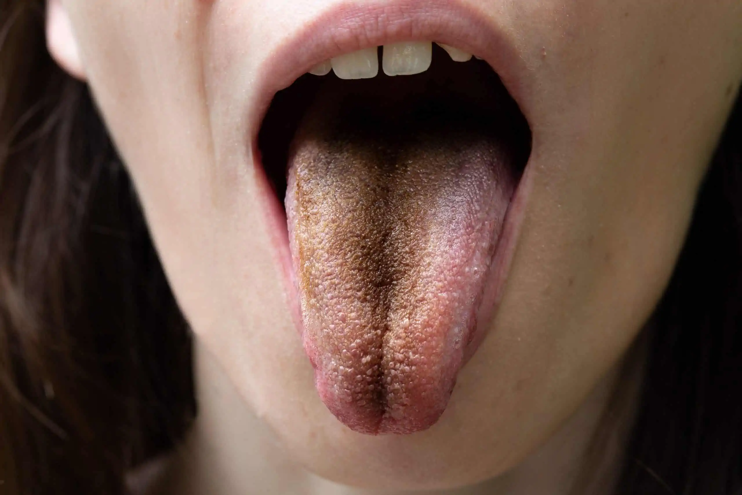 crni jezik - uzrok, simptomi, liječenje