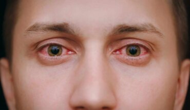 crveno oko – uzrok, simptomi, liječenje