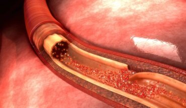 disekcija aorte – uzrok, simptomi, liječenje