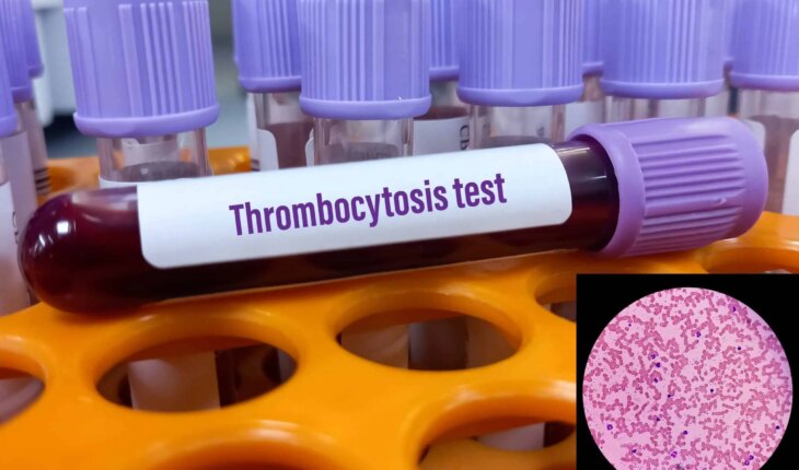 esencijalna trombocitoza – uzrok, simptomi, liječenje