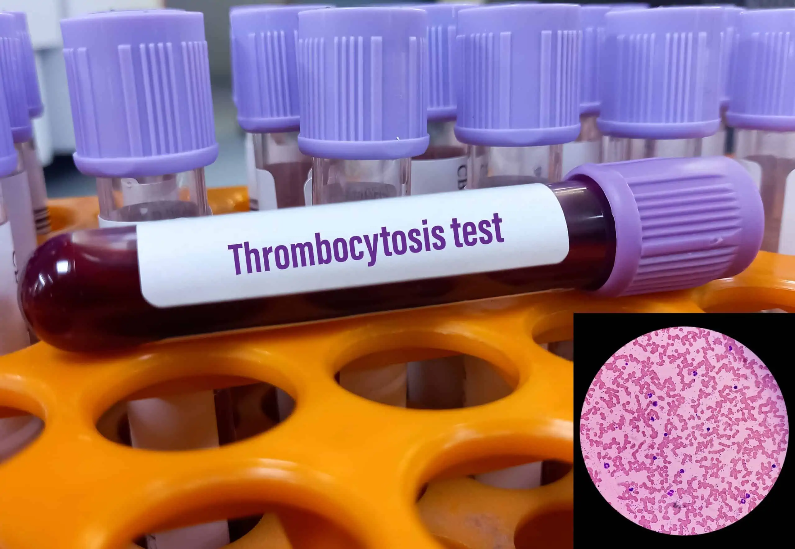 esencijalna trombocitoza - uzrok, simptomi, liječenje