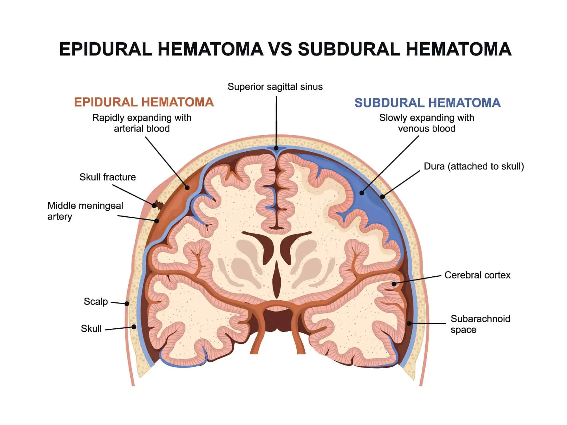 epiduralni hematom - uzrok, simptomi, liječenje