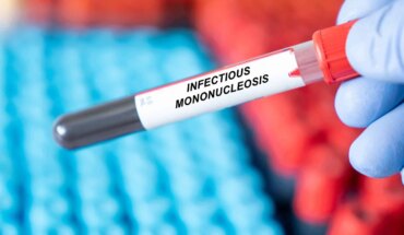 infektivna mononukleoza – bolest poljupca – uzrok, simptomi, liječenje