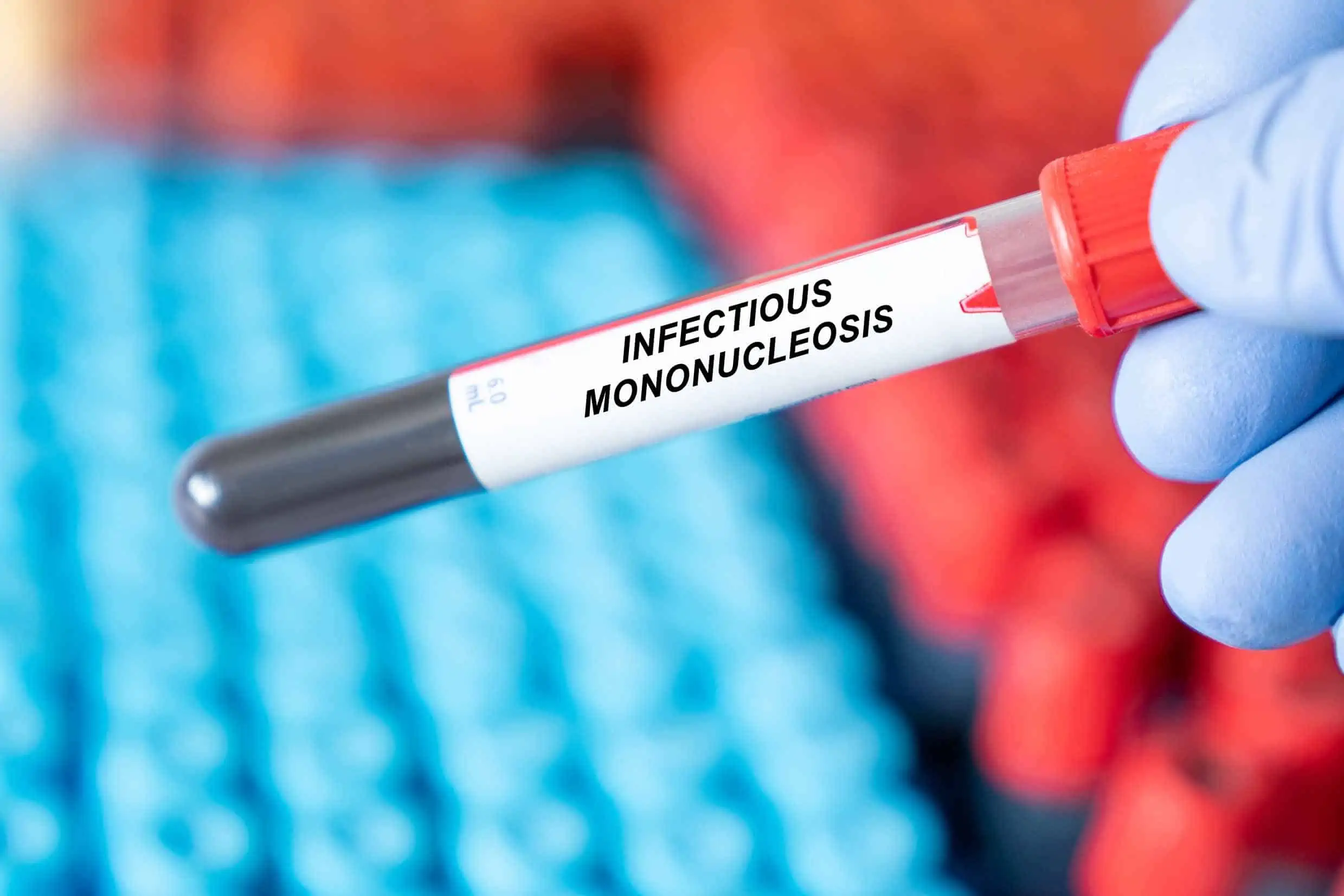 infektivna mononukleoza - bolest poljupca - uzrok, simptomi, liječenje