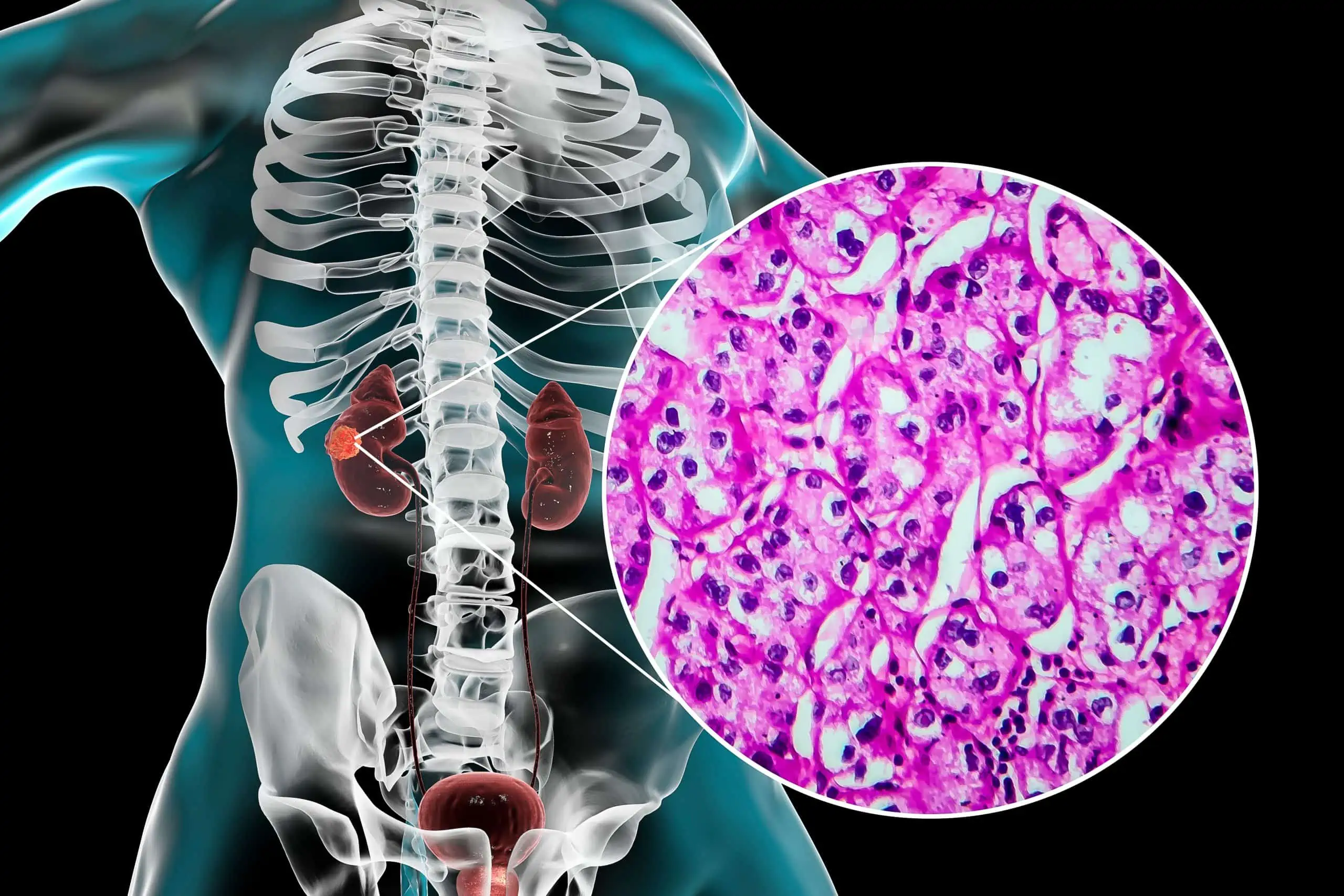 karcinom bubrežnih stanica - uzrok, simptomi, liječenje