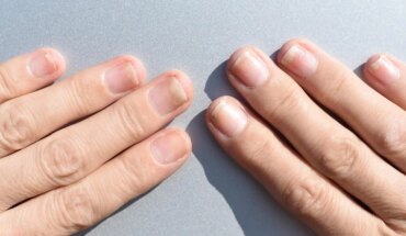 oniholiza – odvajanje nokta od podloge – uzrok, simptomi, liječenje