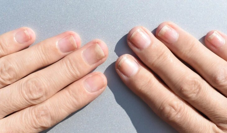oniholiza – odvajanje nokta od podloge – uzrok, simptomi, liječenje