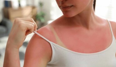 opekline od sunca – uzrok, simptomi, liječenje