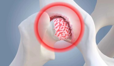 osteoartritis – najčešća bolest zglobova