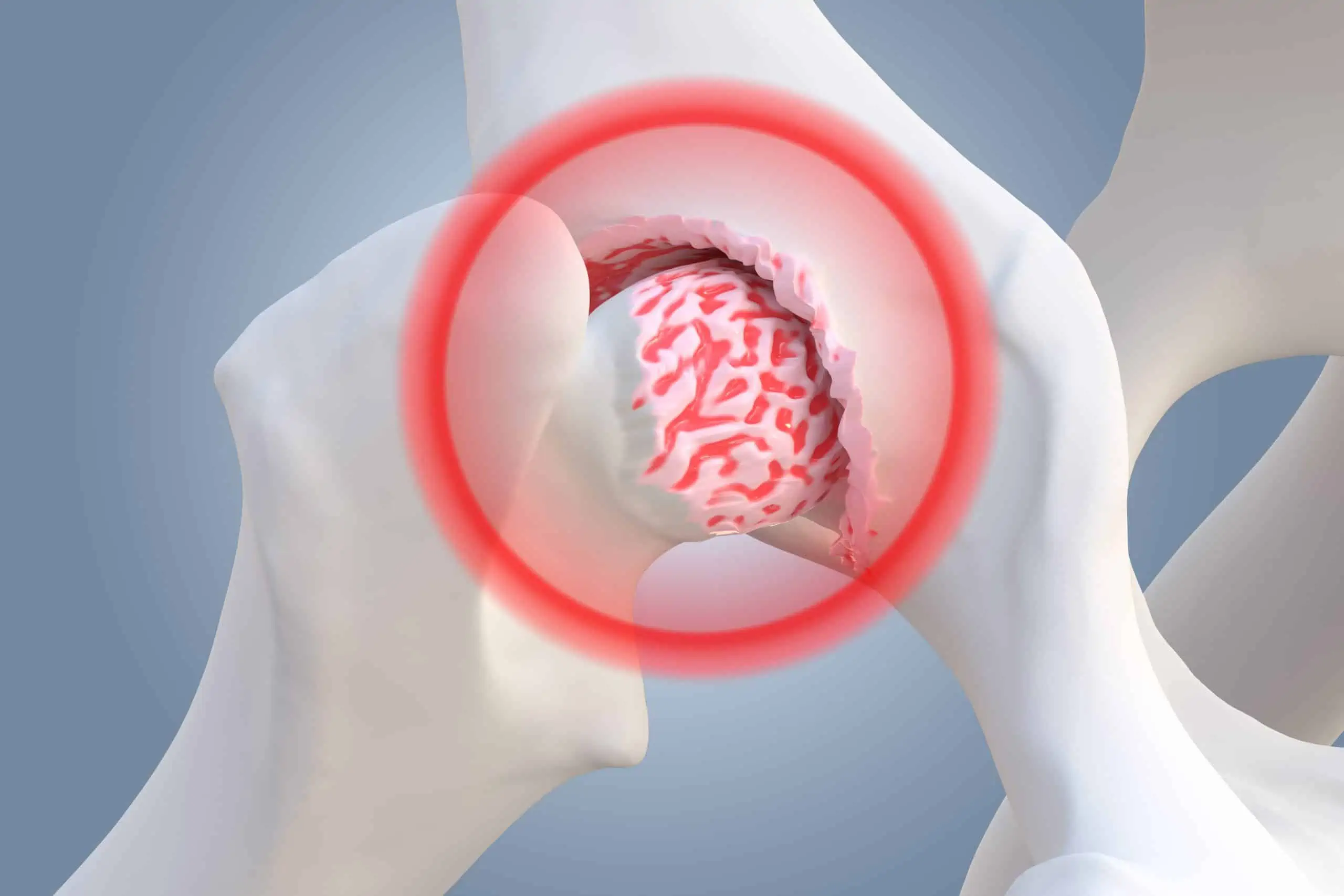osteoartritis - najčešća bolest zglobova