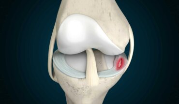 ozljede meniska koljena – uzrok, simptomi, liječenje