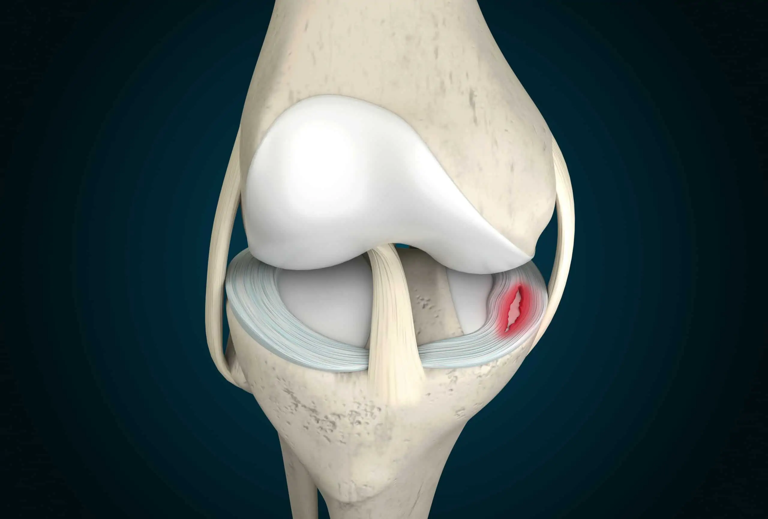 ozljede meniska koljena - uzrok, simptomi, liječenje