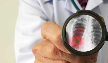pneumonije uzrokovane respiratornim virusima – uzrok, simptomi, liječenje