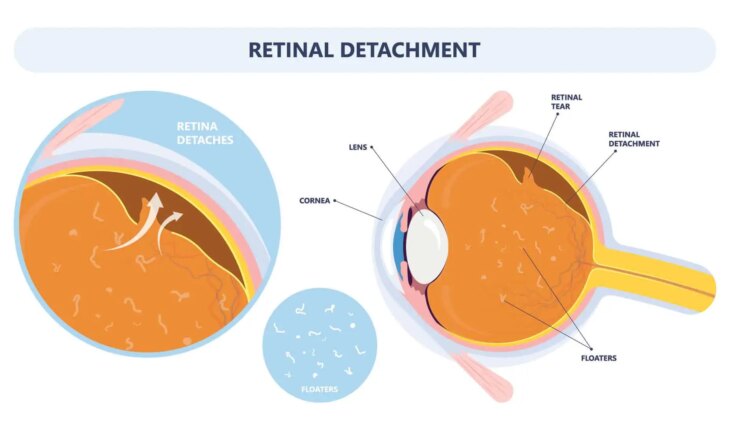 retinoshiza – uzrok, simptomi, liječenje