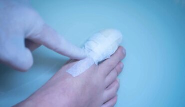 slomljeni nožni prst – uzrok, simptomi, liječenje