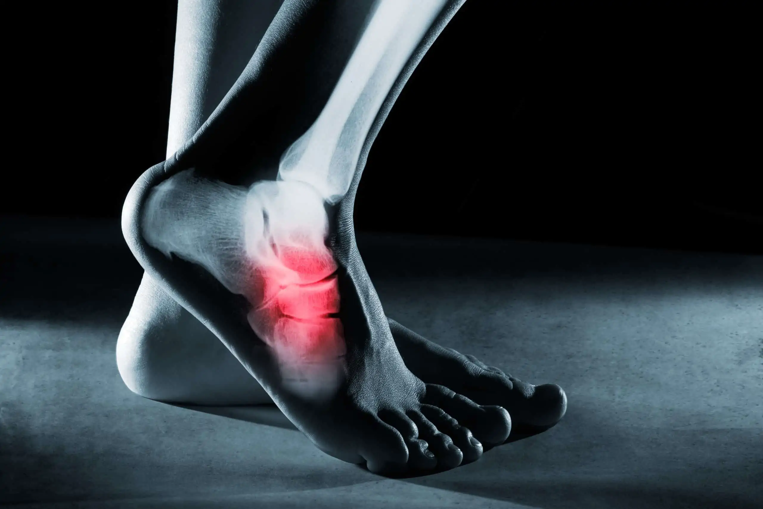 slomljeno stopalo (gležanj) - uzrok, simptomi, liječenje