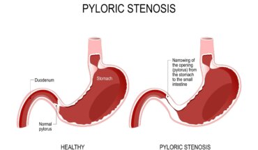 stenoza pilorusa – uzrok, simptomi, liječenje