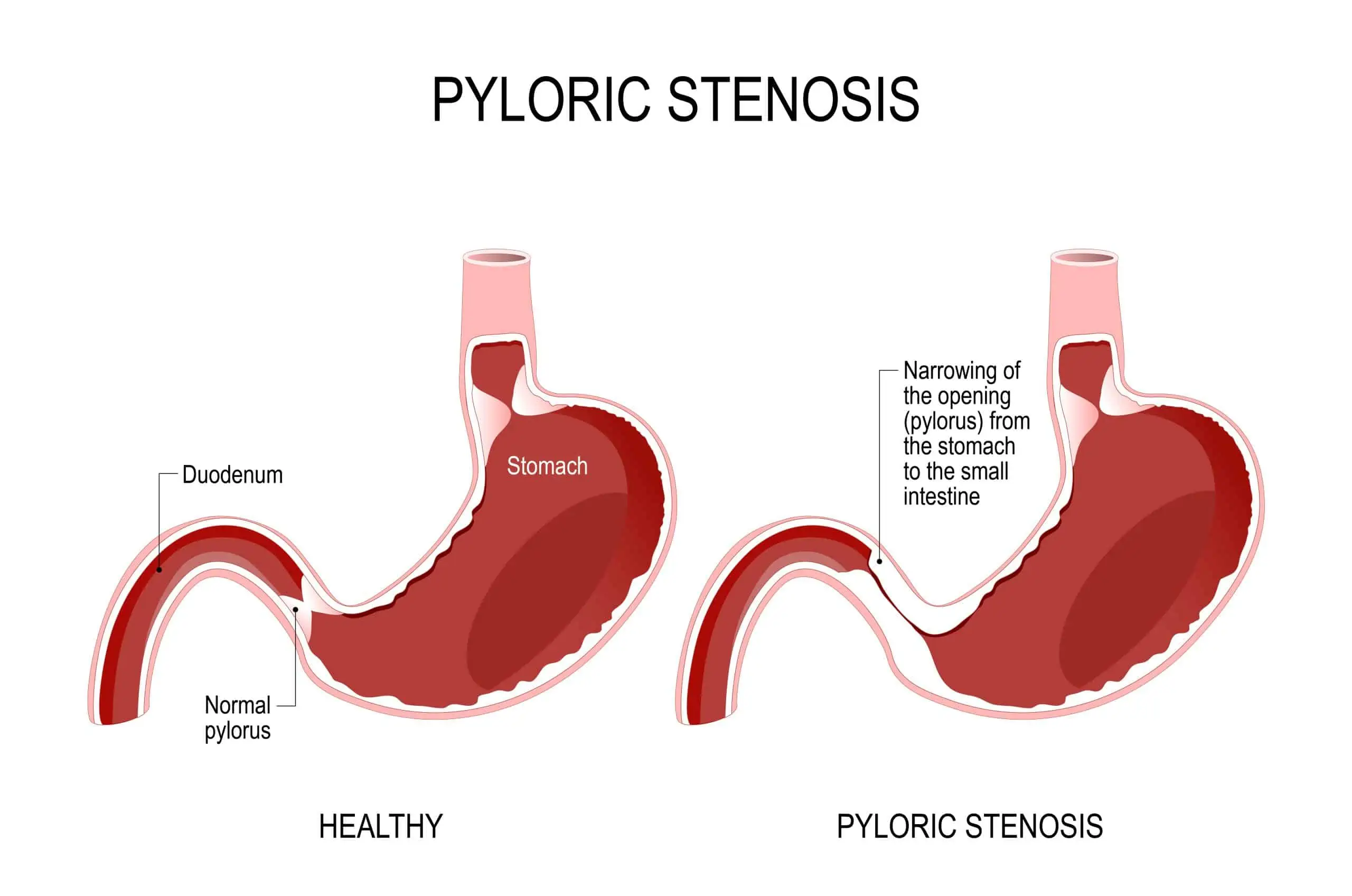 stenoza pilorusa - uzrok, simptomi, liječenje