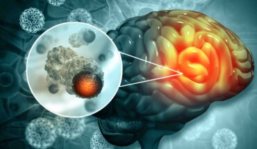 tumori mozga – uzrok, simptomi, liječenje