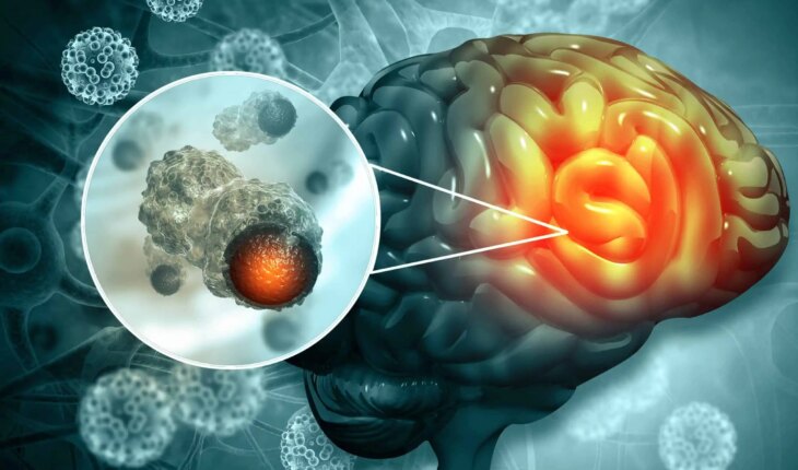 tumori mozga – uzrok, simptomi, liječenje