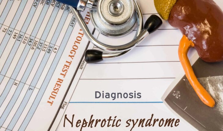 što je nefrotski sindrom – uzrok, simptomi, liječenje