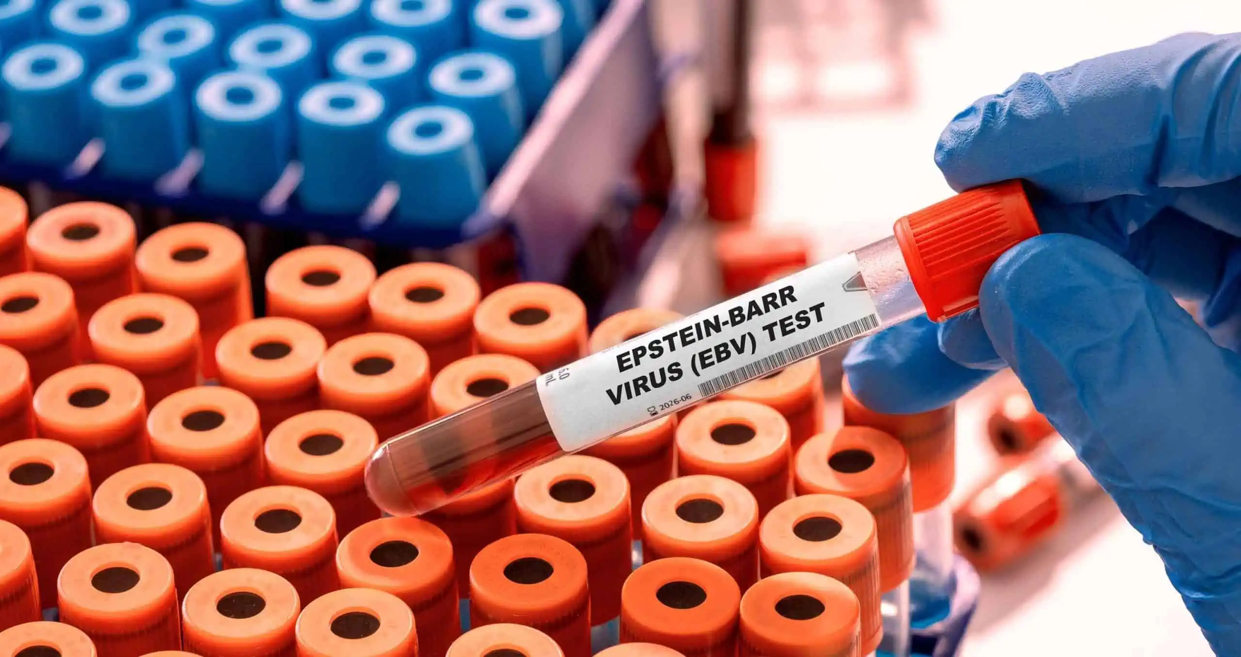 Epstein barr virus – uzrok, simptomi, liječenje