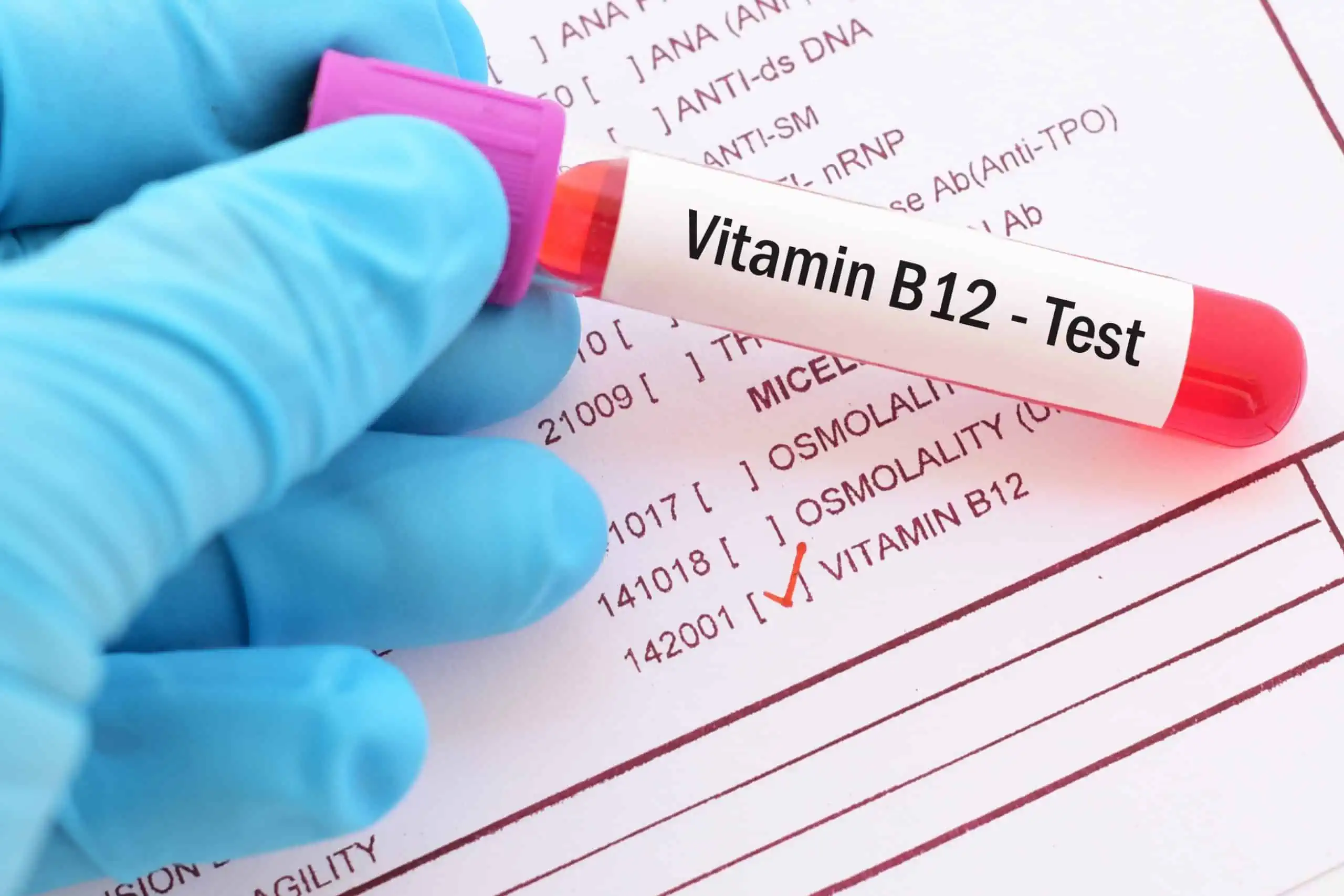 Višak vitamina B12 u krvi – uzrok, simptomi, liječenje