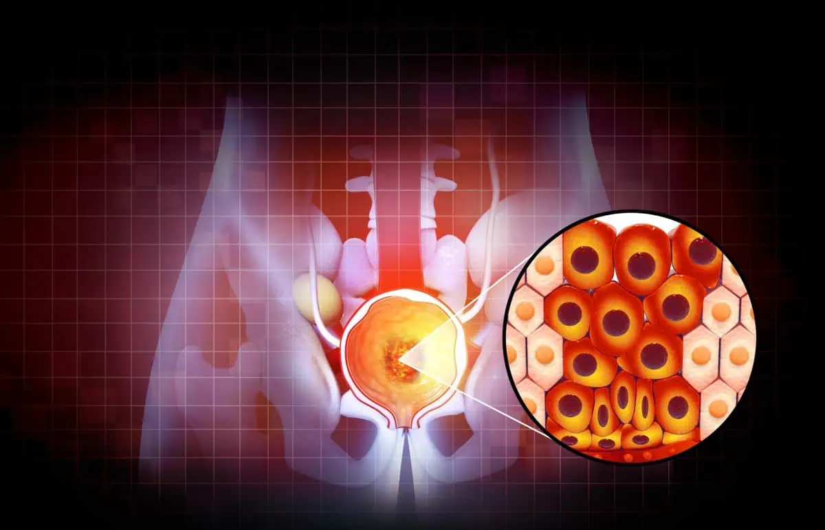 Biopsija prostate kako se radi
