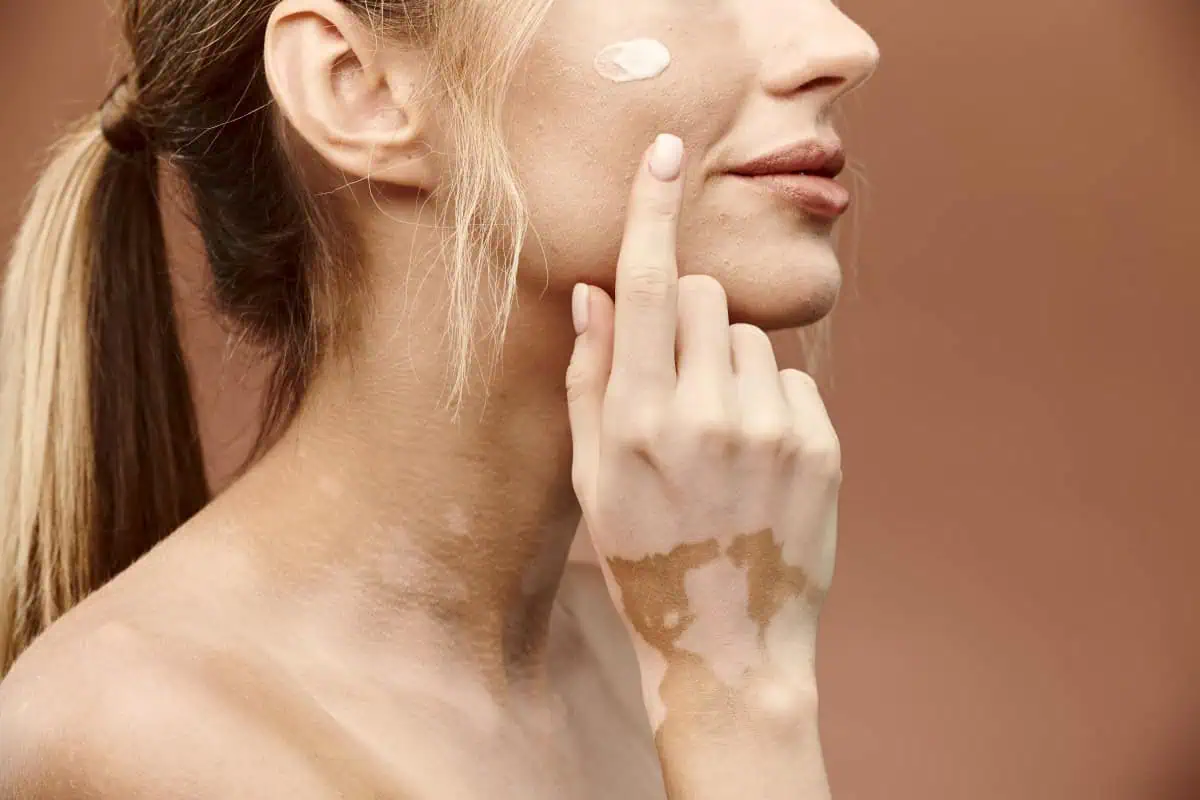Kako zaustaviti vitiligo – AdresarSporta.rs